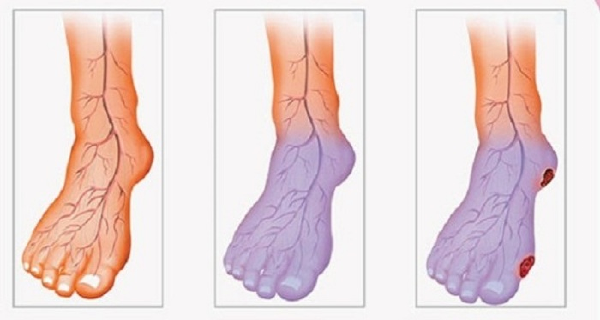 Poor Blood Circulation, Cold Legs and Hands? Here is What You Can do