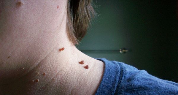 How To Quickly Remove Skin Tags With One Ingredient