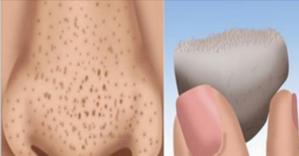 How To Get Rid Of Blackheads Quickly At Home! Fast And Easy Natural Remedies!