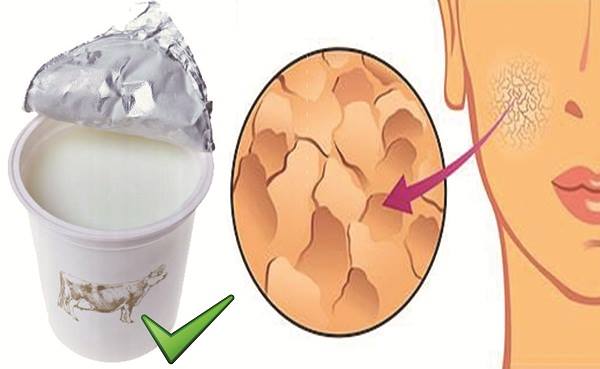 How To Treat Dry and Itchy Skin With Yogurt