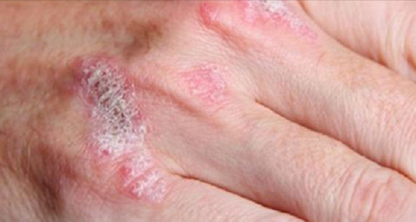 The Miraculous Plant Which Treats Psoriasis, Eczema, Dermatitis and Other Skin Allergies!