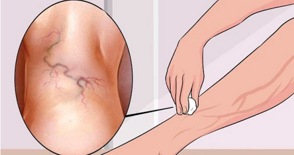 Get Rid of Varicose Veins Forever With The Use of One Simple Ingredient!