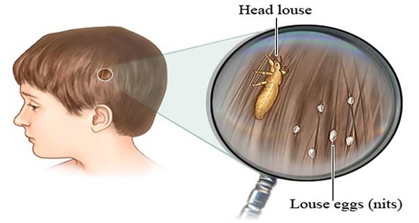 Doctors Won’t Tell You This – Ched Of The Heap Way To Get Riad Lice Almost Instantly