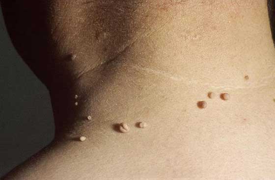 Quick, Easy, Cheap Home Remedy To Get Rid Of Skin Tags