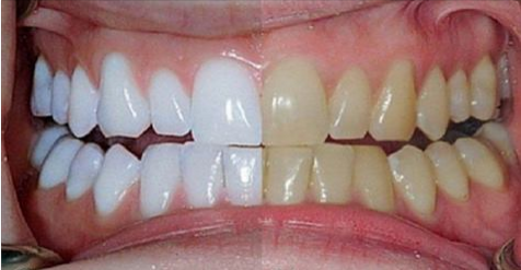 She puts these two ingredients on her teeth and the result is just amazing!