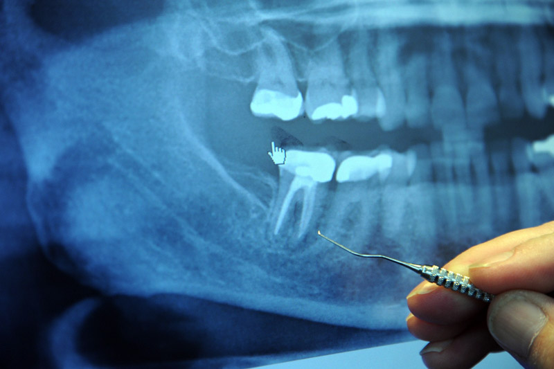 Goodbye Dental Implants, Grow Your Own Teeth In Just 9 Weeks