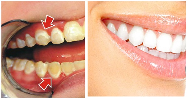 Be Your Own Dentist! See How to Remove the Plaque From Teeth in Just 5 Minutes!