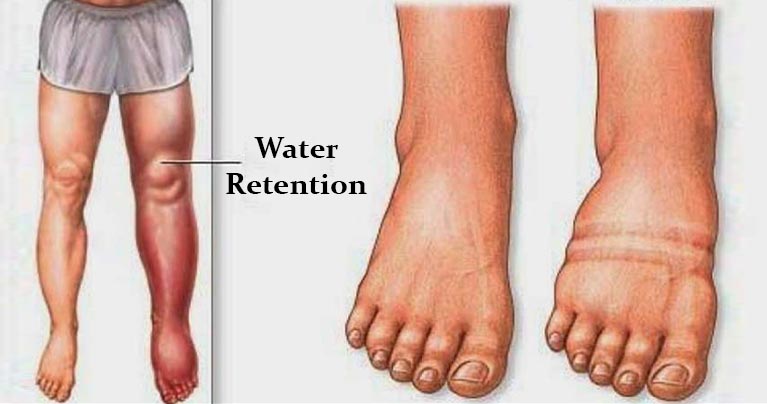 What Causes Water Retention and How to Avoid It