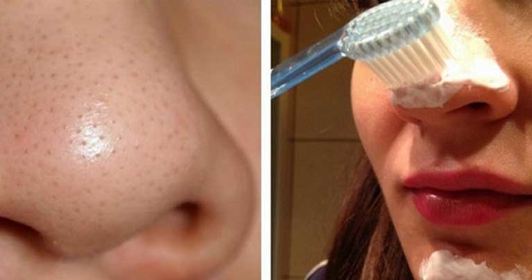 You Won’t Believe How Easy It Is to Get Rid of Blackheads!