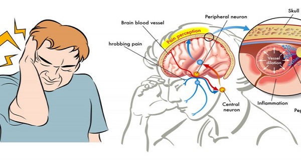 Here is How To Instantly Stop A Migraine With Salt