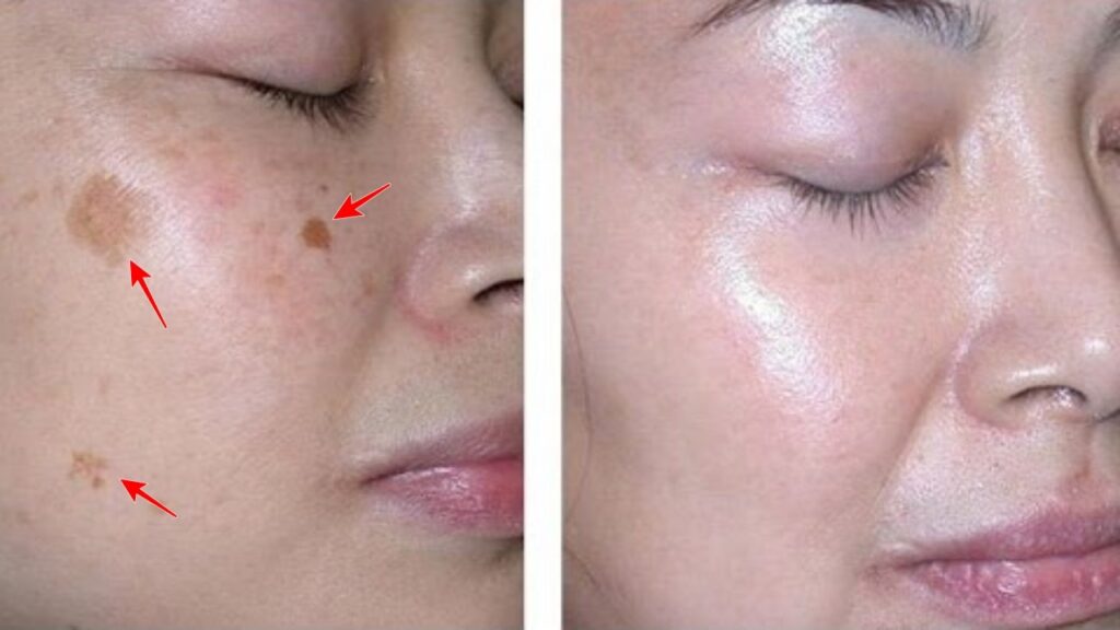 How to Remove Spots From Your Face In Just 3 Nights!