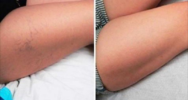 My Thighs And Legs Had Varicose Veins, But Thank To This Prescription Eliminated all!