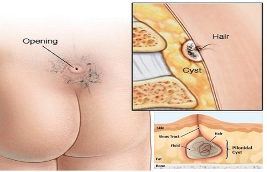 What is a Pilonidal Cyst and What Causes it?