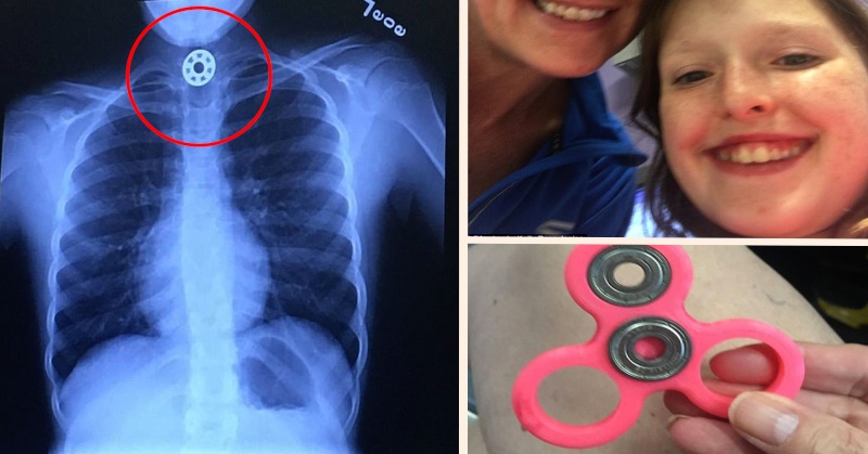 Girl Nearly Chokes To Death After Swallowing Part Of Popular Toy