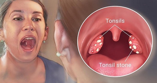 4 Effective Ways to Remove Tonsil Stones without Surgery