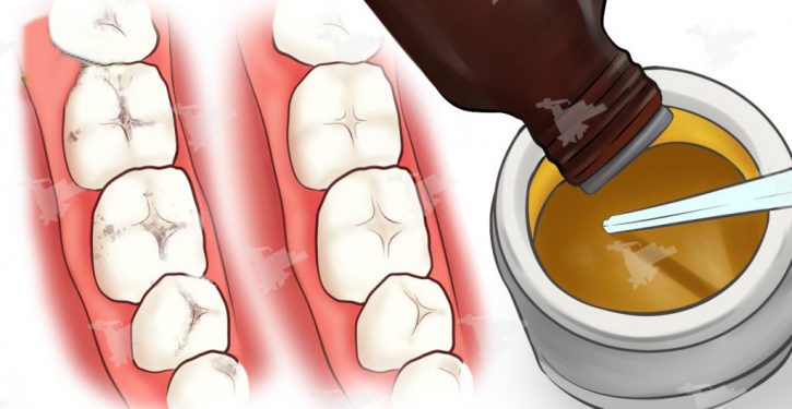 Soigner naturellement vos caries et la détérioration des dents à l’aide de ce puissant remède