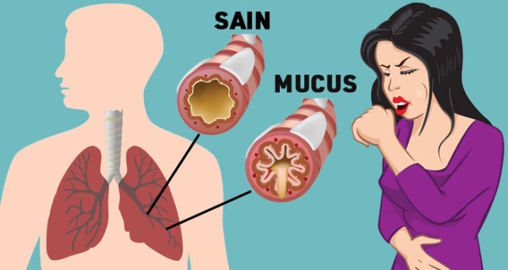 Comment se débarrasser du mucus dans vos poumons et votre gorge