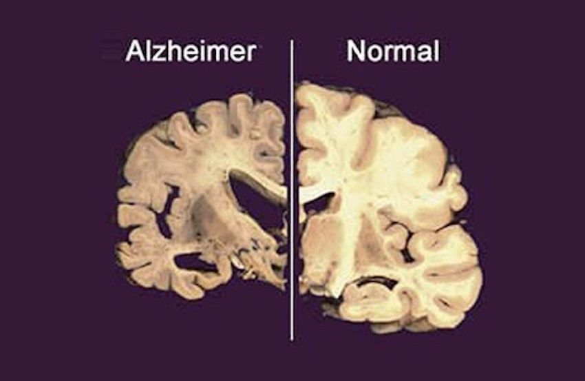 Alzheimer aurait un lien avec le manque de sommeil